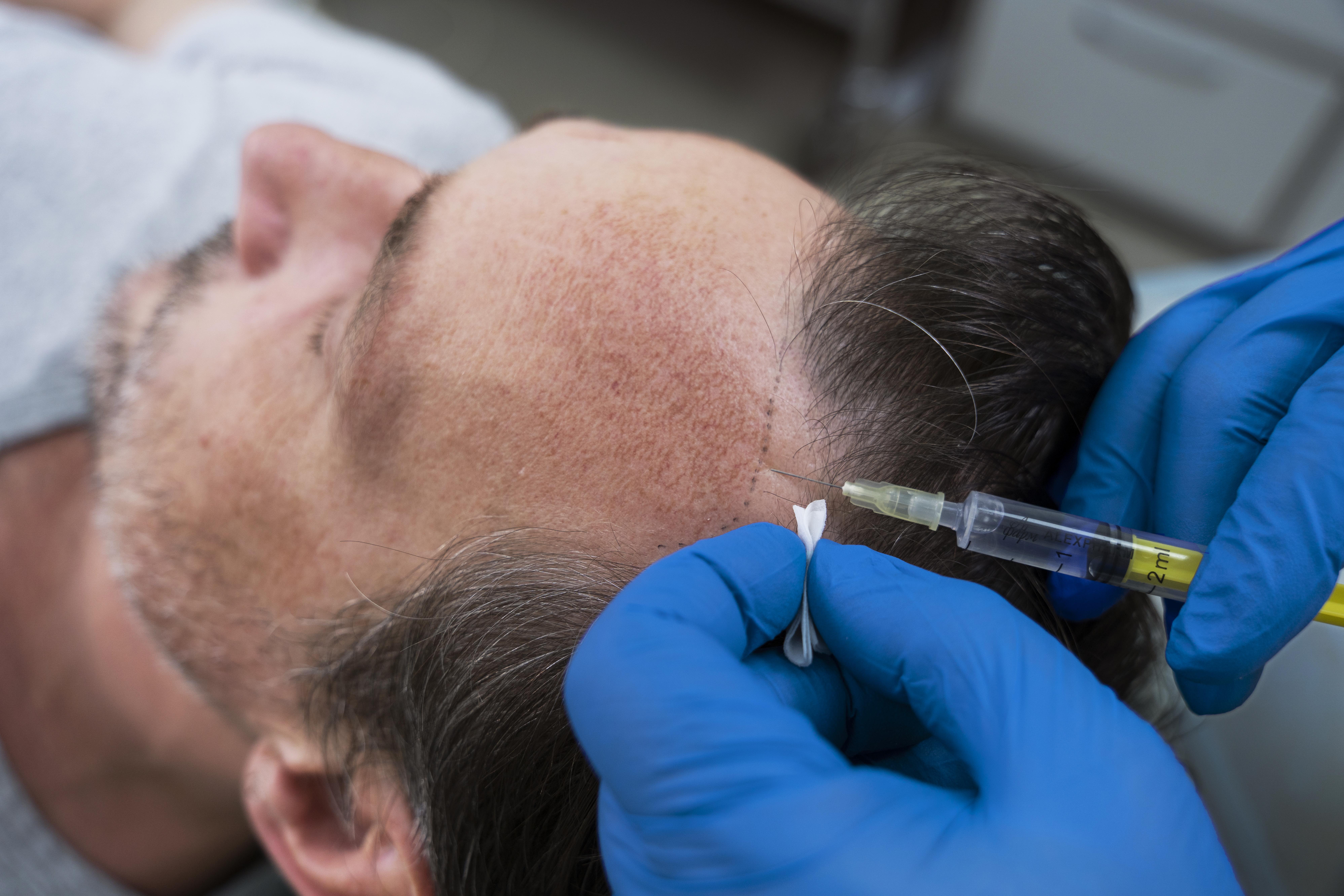 Hair PRP vs. Hair Transplants: Which Treatment Is Right for You?